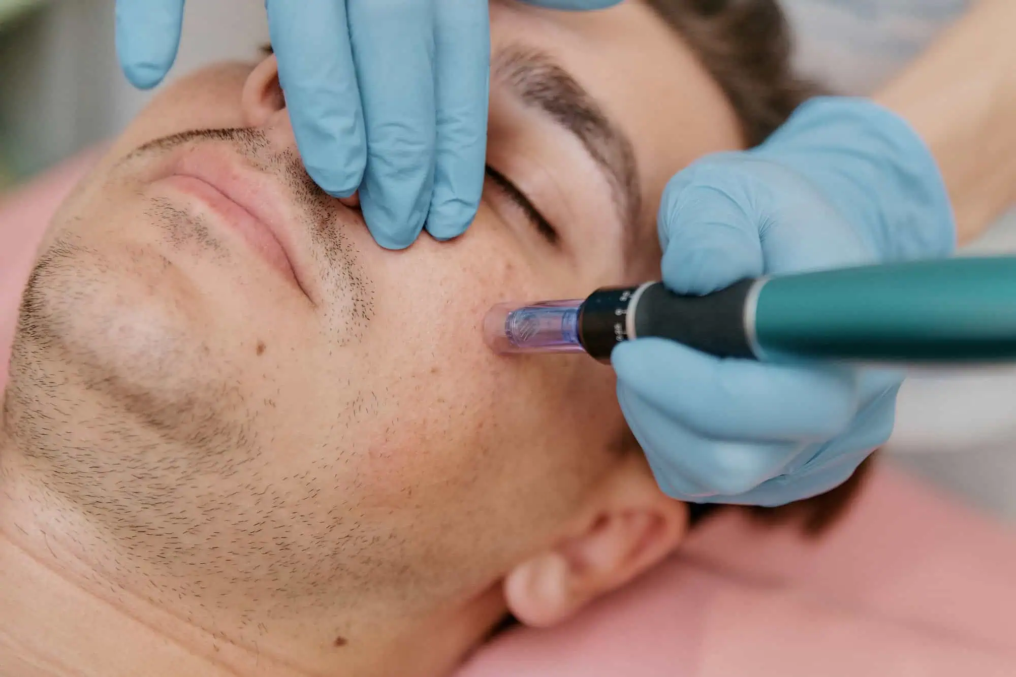 Microneedling in Corpus Christi, TX