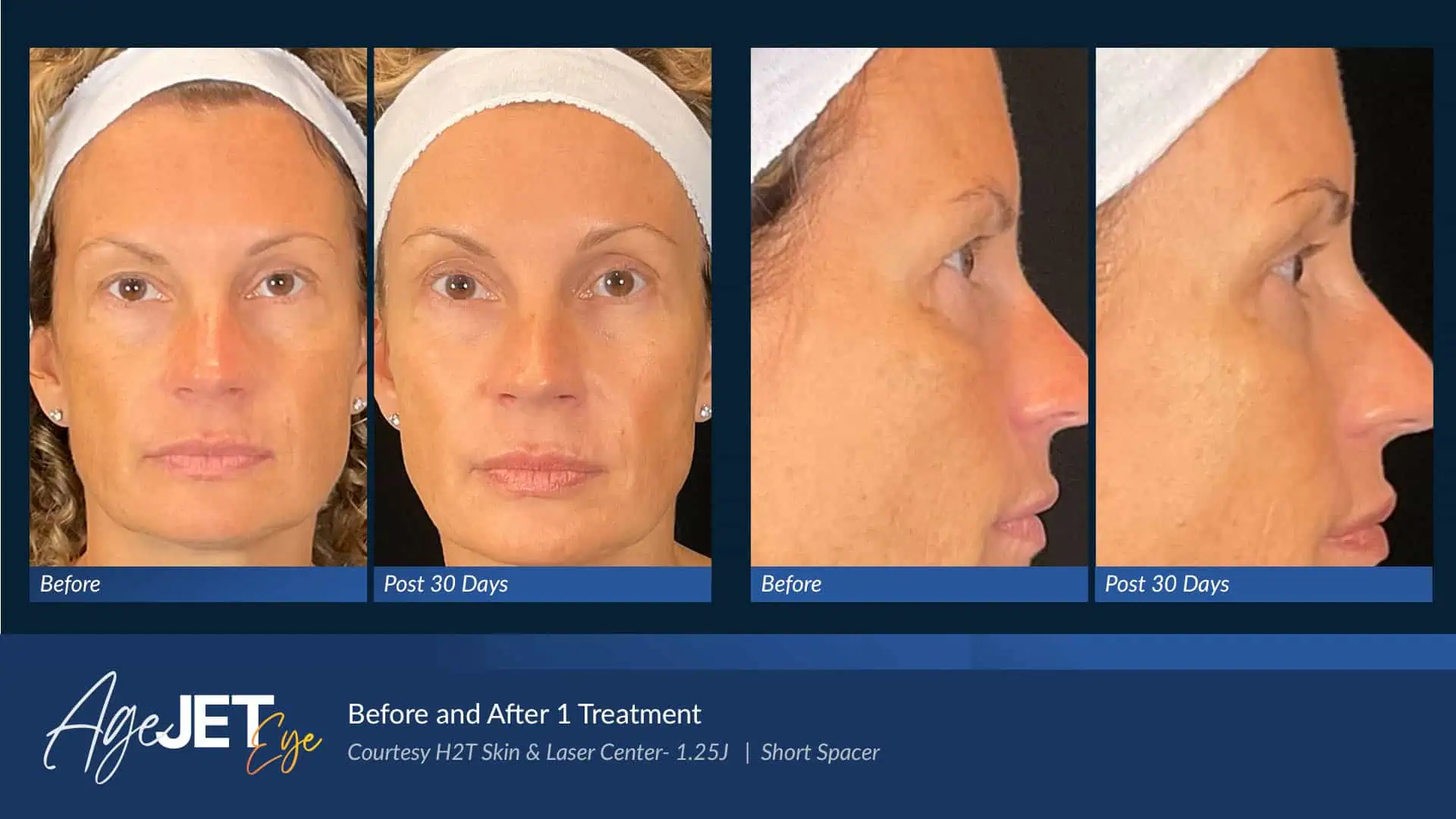 AgeJET Before and Afters | Coastal Glo Med Spa