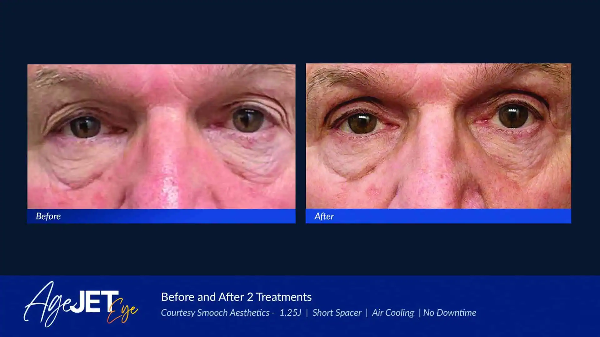 Age JET Eye Male Smooch Aesthetics | Coastal Glo Med Spa