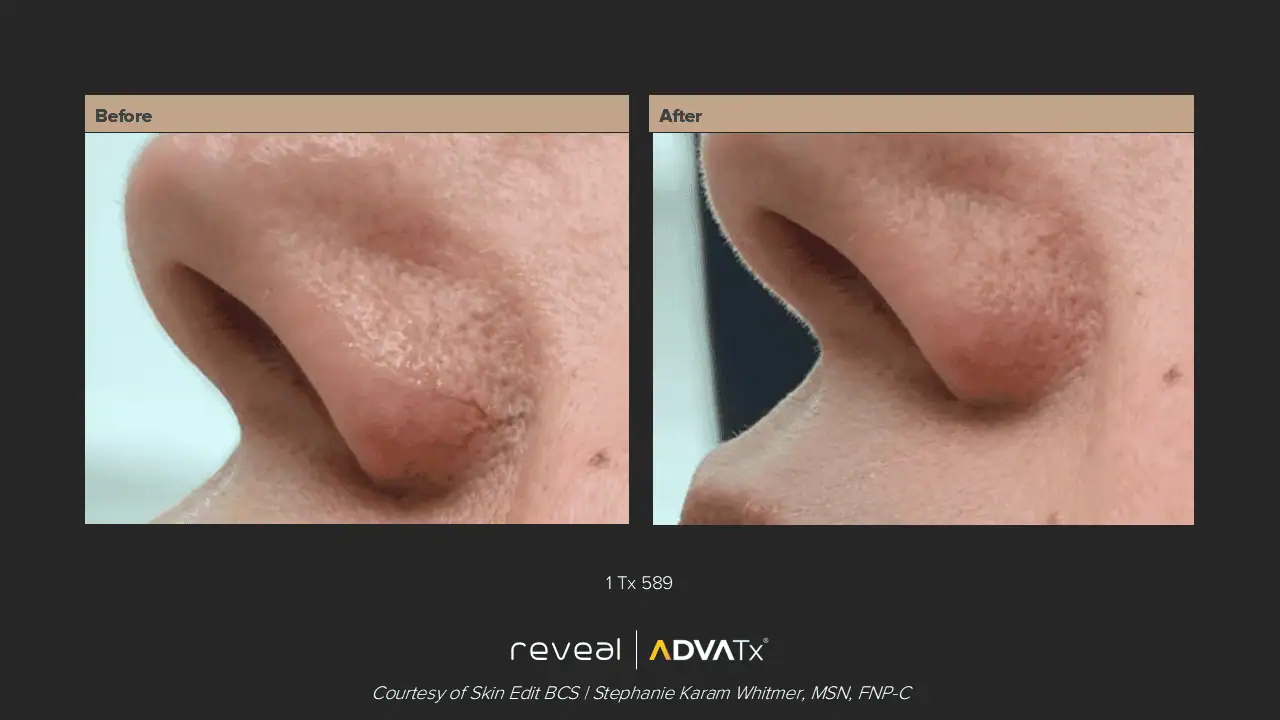 ADVATx BA | Corpus Christi, TX | Coastal Glo Med Spa