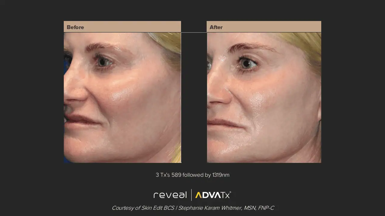 ADVATx BA | Corpus Christi, TX | Coastal Glo Med Spa