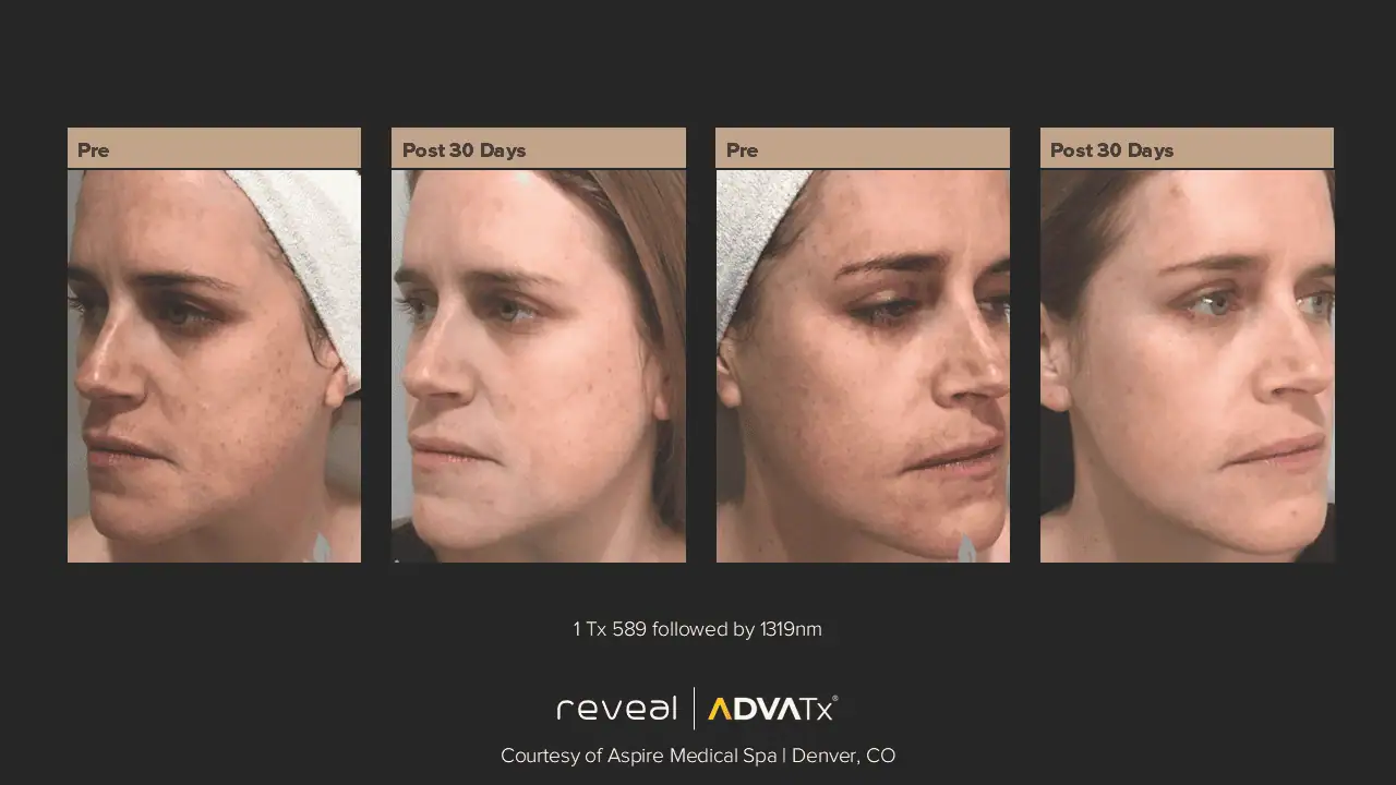 ADVATx | Corpus Christi, TX | Coastal Glo Med Spa
