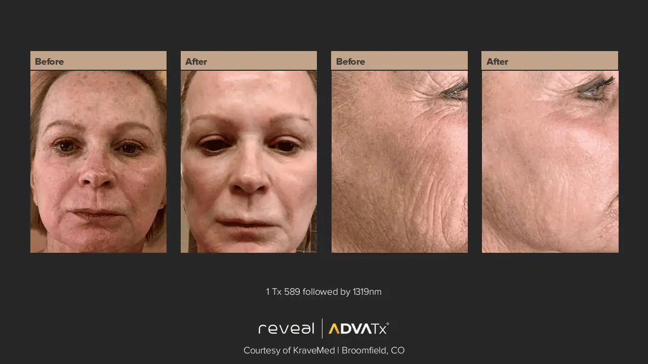 ADVATx | Corpus Christi, TX | Coastal Glo Med Spa