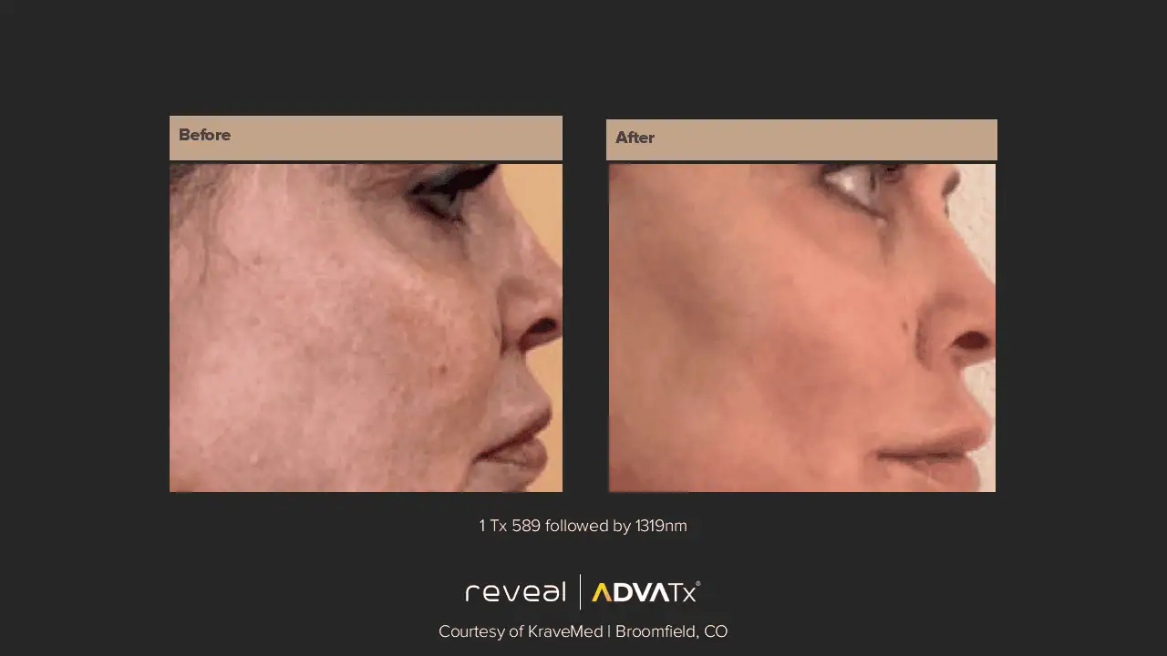 ADVATx | Corpus Christi, TX | Coastal Glo Med Spa