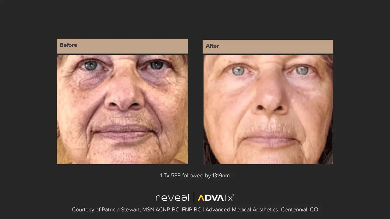 ADVATx | Corpus Christi, TX | Coastal Glo Med Spa