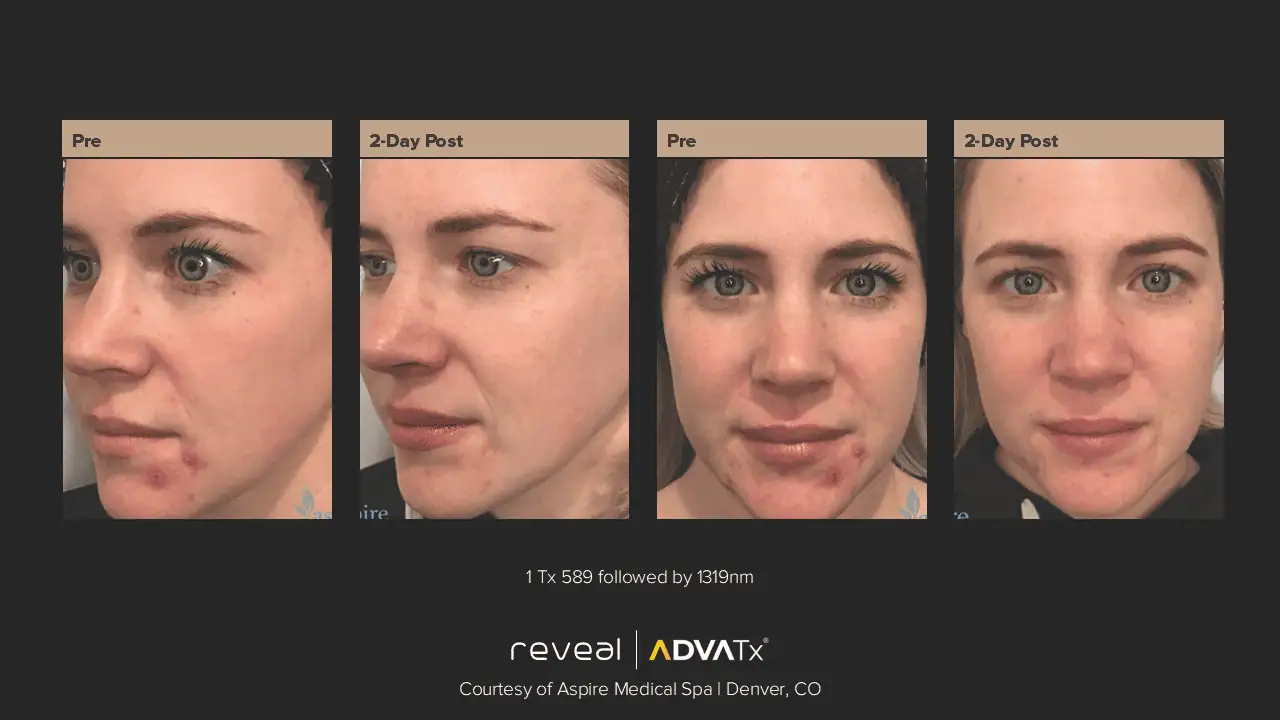 ADVATx | Corpus Christi, TX | Coastal Glo Med Spa