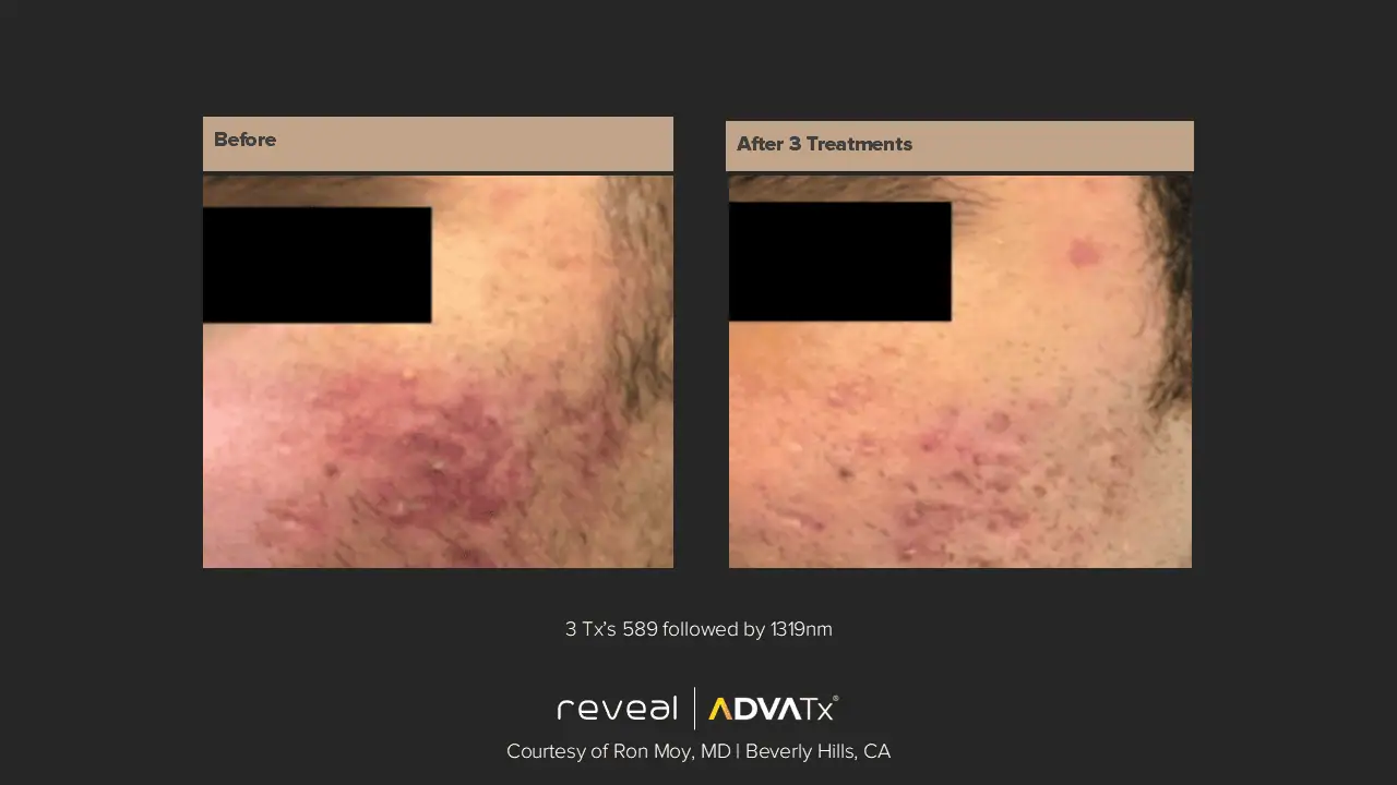 ADVATx | Corpus Christi, TX | Coastal Glo Med Spa
