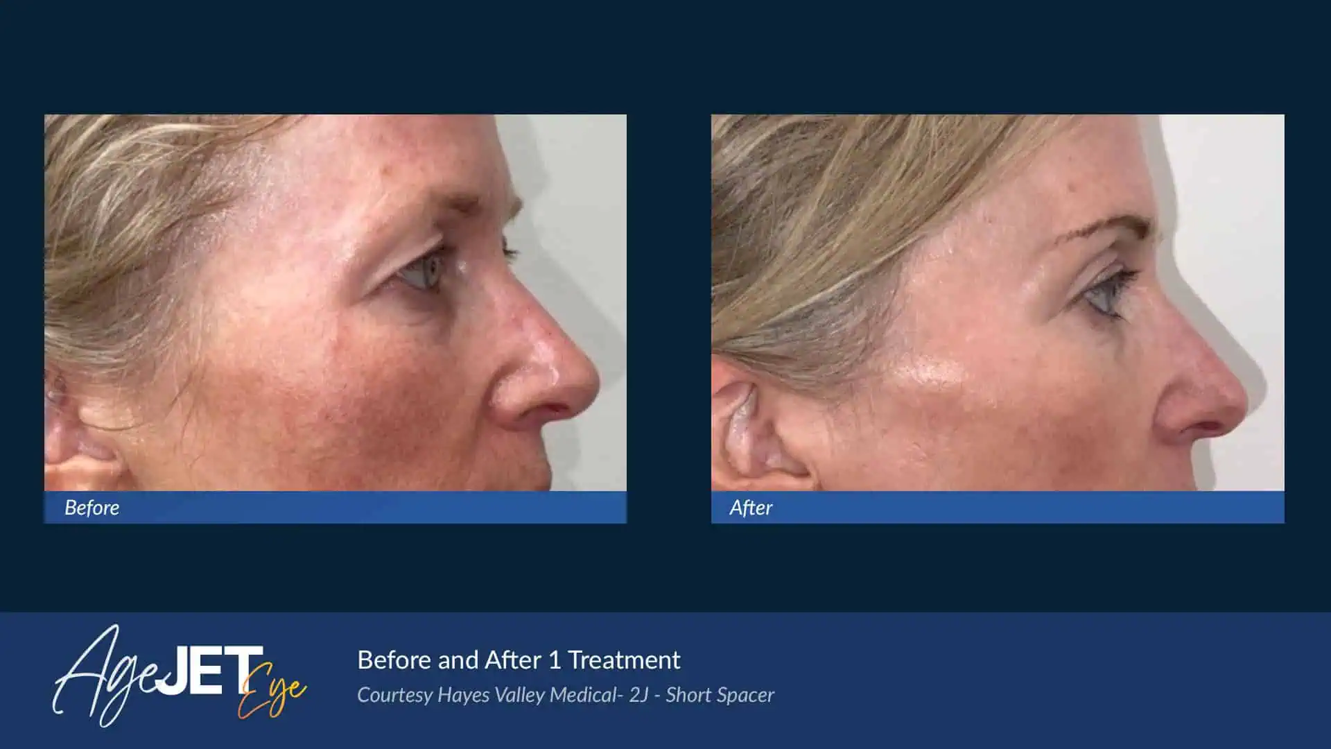 Medical AgeJET Smooth Female | Corpus Christi, TX | Coastal Glo Med Spa