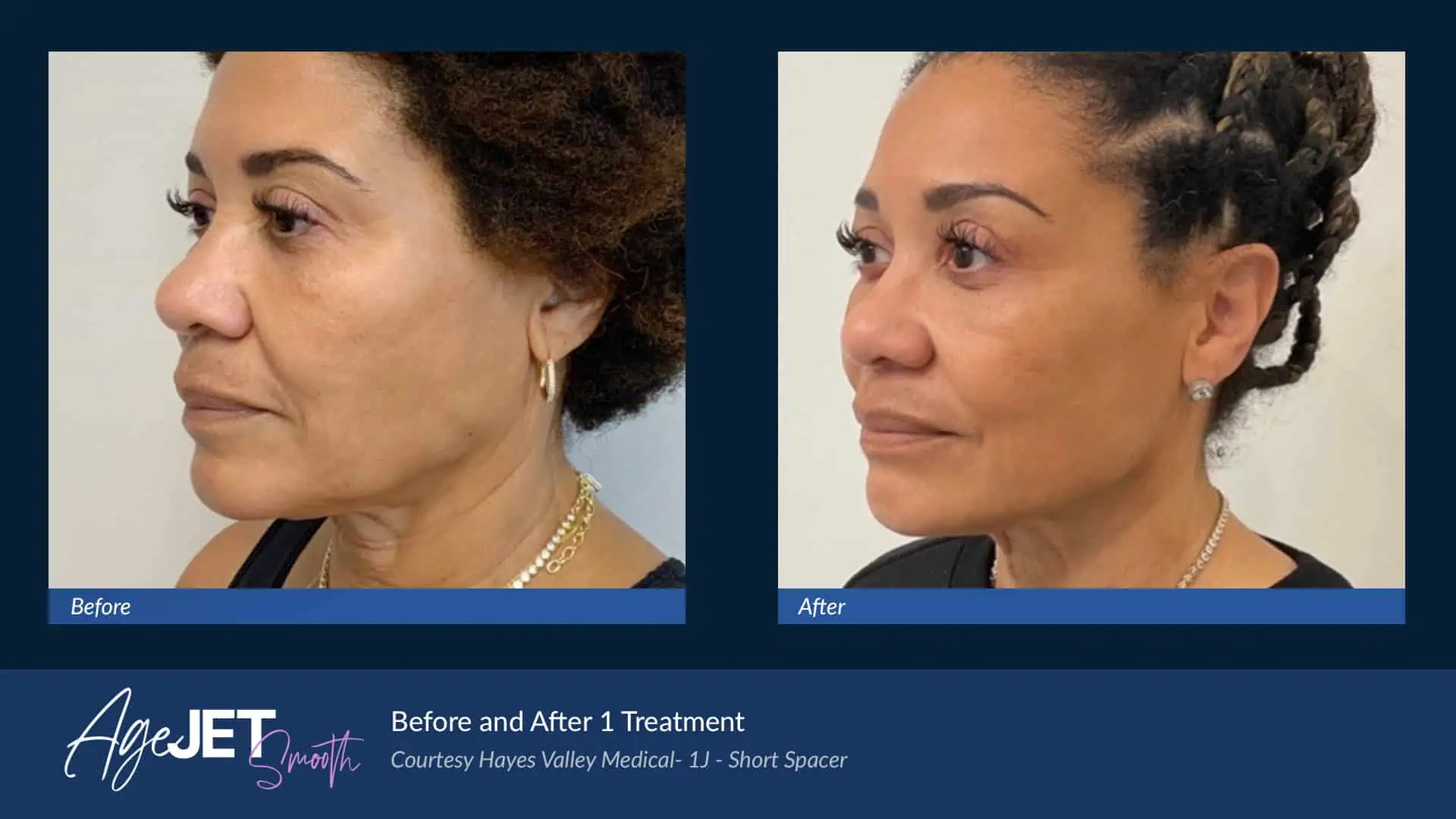 Medical AgeJET Smooth Female | Corpus Christi, TX | Coastal Glo Med Spa