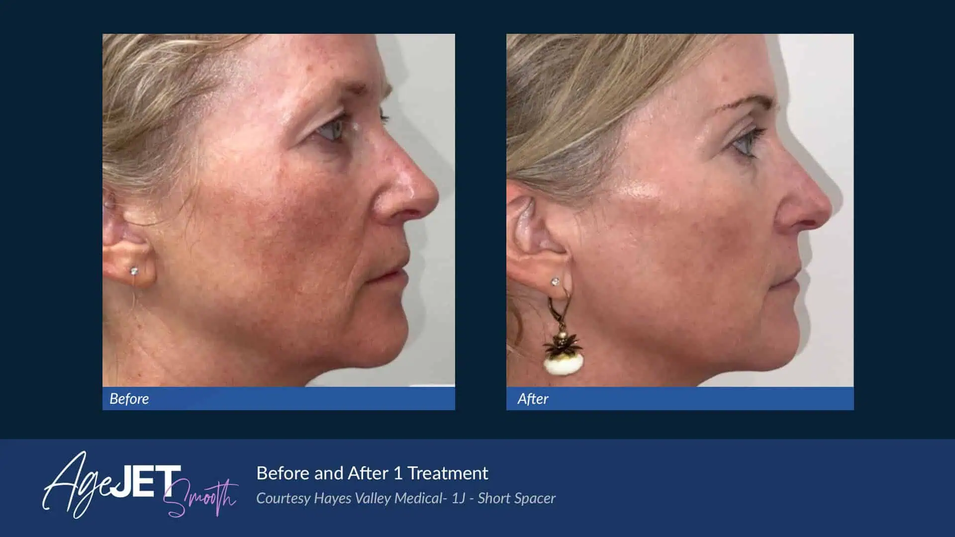 Medical AgeJET Smooth Female | Corpus Christi, TX | Coastal Glo Med Spa