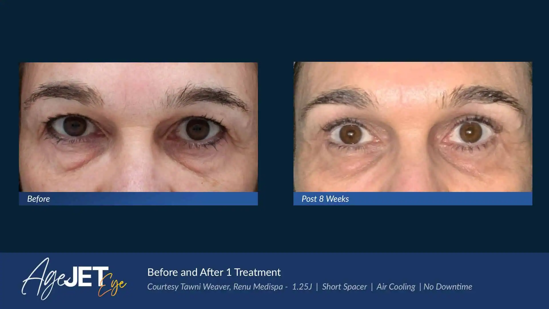 AgeJET Before and Afters Age | Corpus Christi, TX | Coastal Glo Med Spa