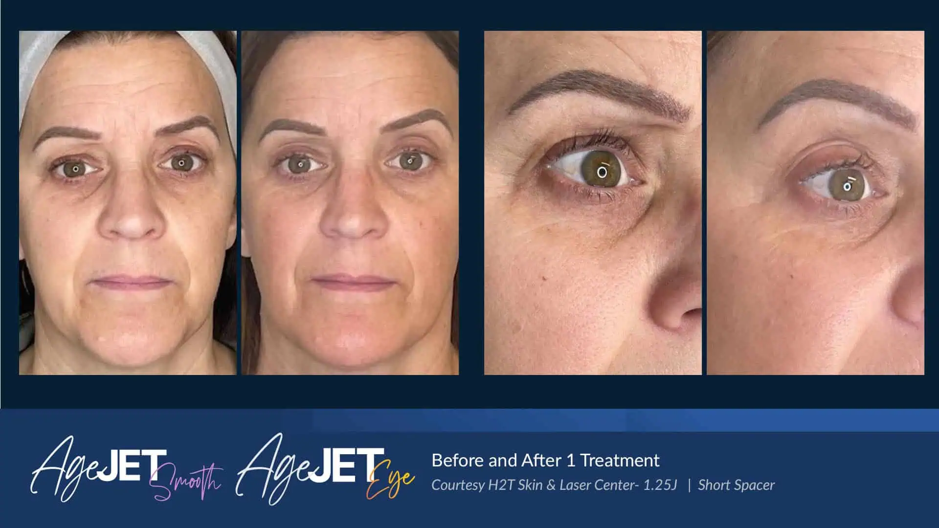 AgeJET Before and Afters | Corpus Christi, TX | Coastal Glo Med Spa