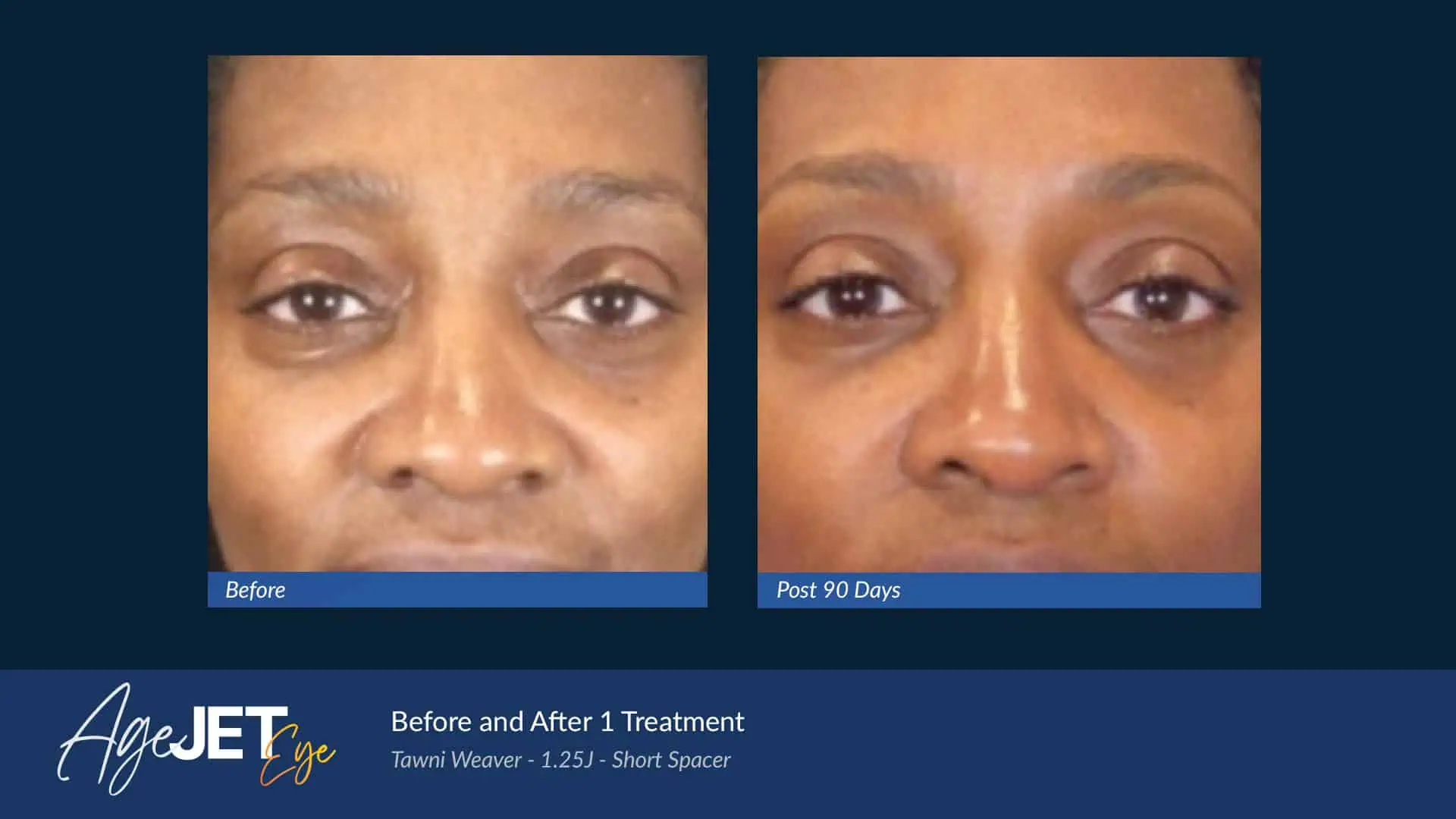 AgeJET Eye Female Deep | Corpus Christi, TX | Coastal Glo Med Spa