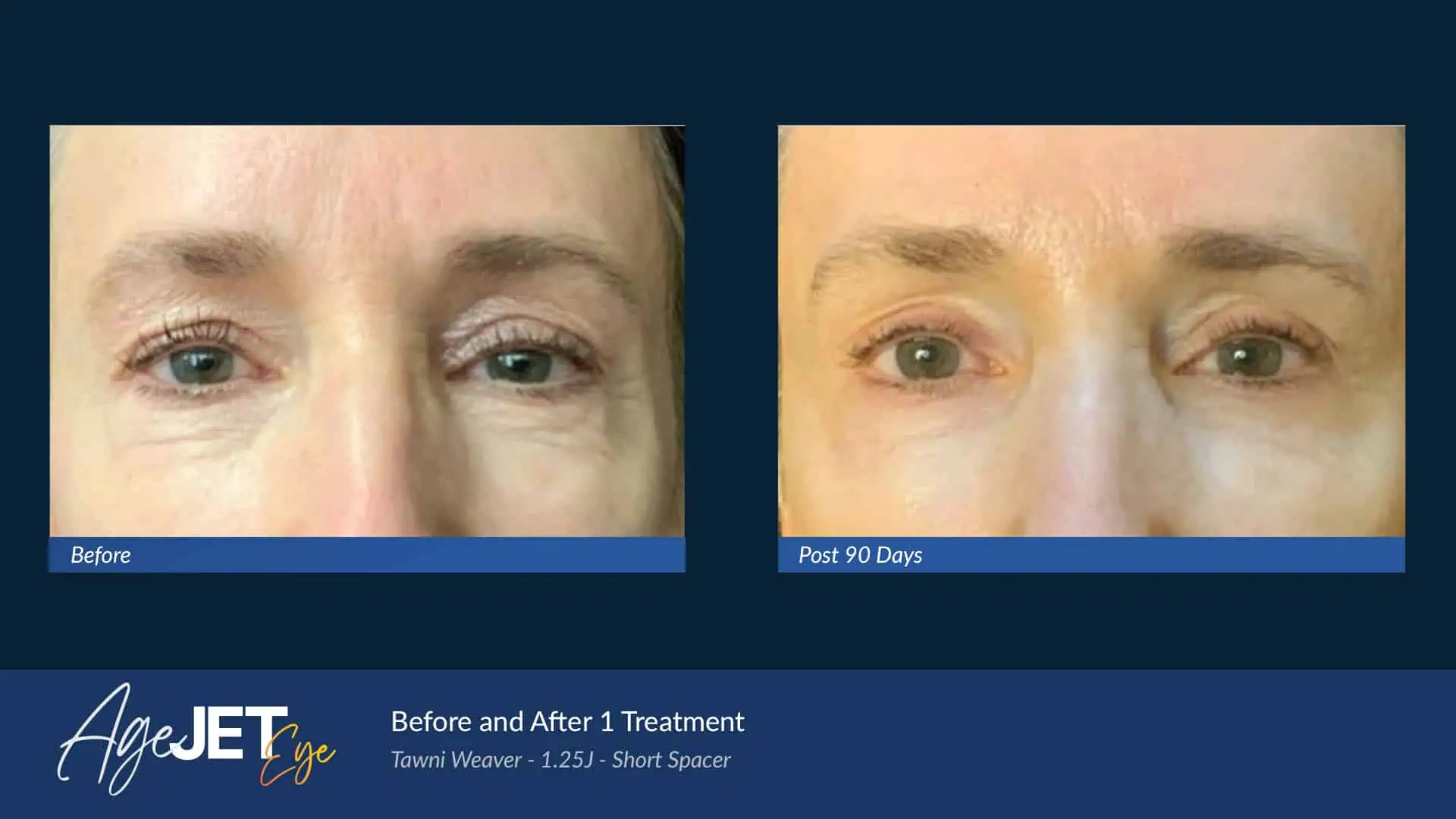 AgeJET Eye Female Weaver | Corpus Christi, TX | Coastal Glo Med Spa