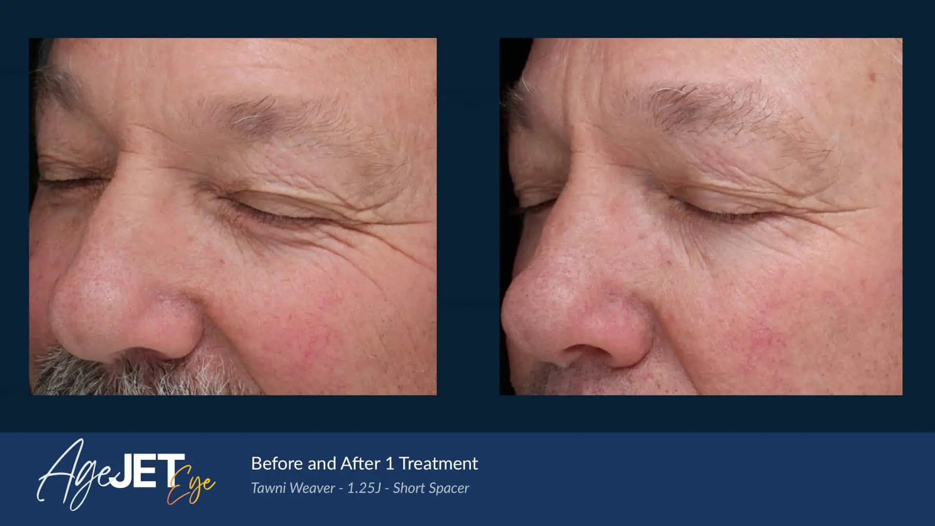 AgeJET Eye Male Weaver | Corpus Christi, TX | Coastal Glo Med Spa