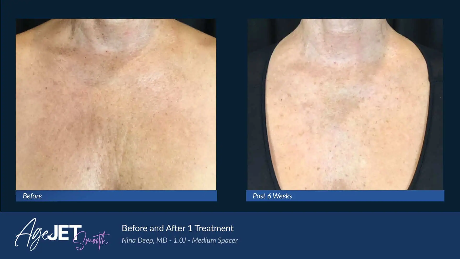 AgeJet Smooth Femaie Deep Chest | Corpus Christi, TX | Coastal Glo Med Spa