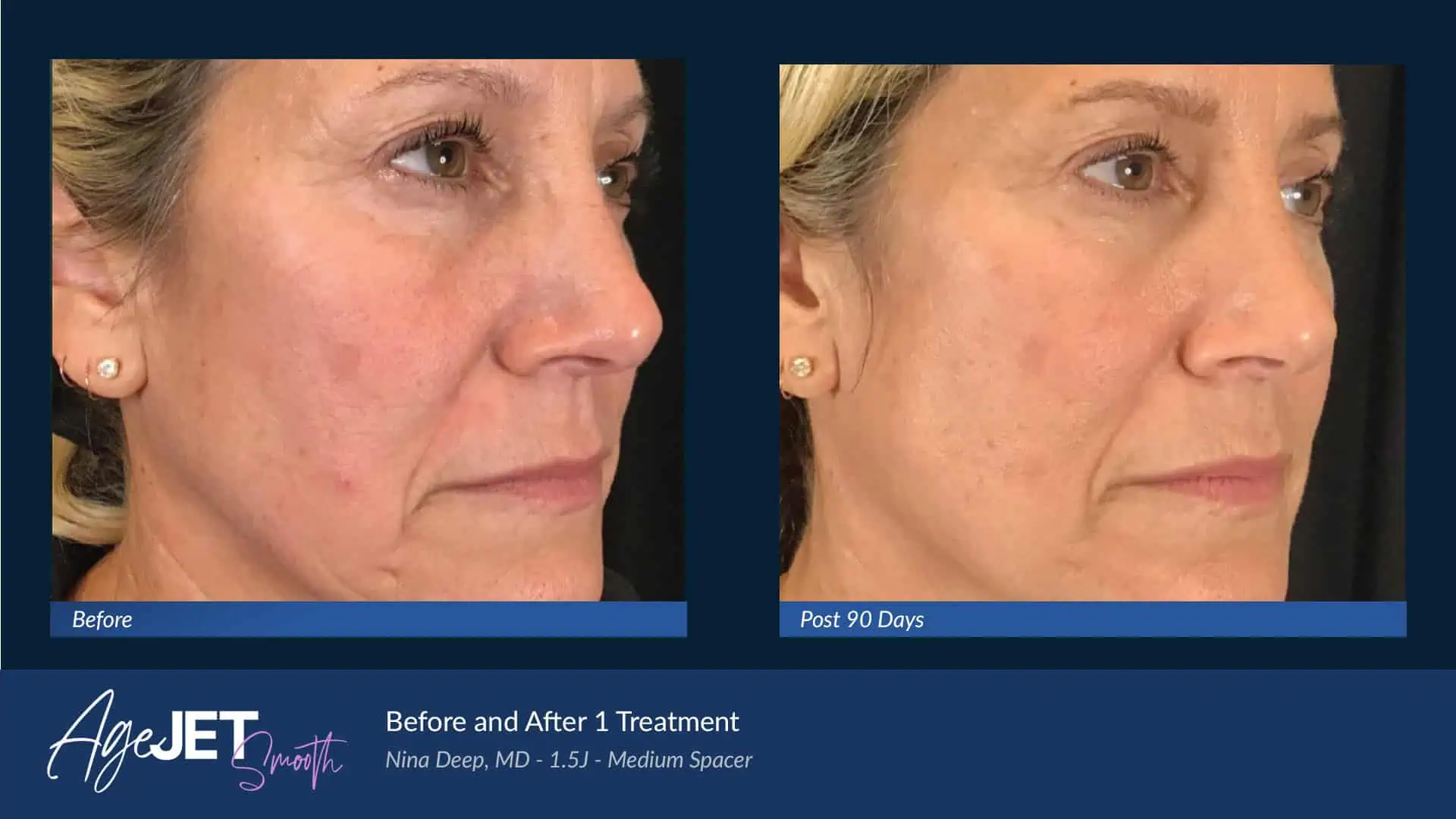 BA AgeJet Smooth Femaie Deep | Corpus Christi, TX | Coastal Glo Med Spa