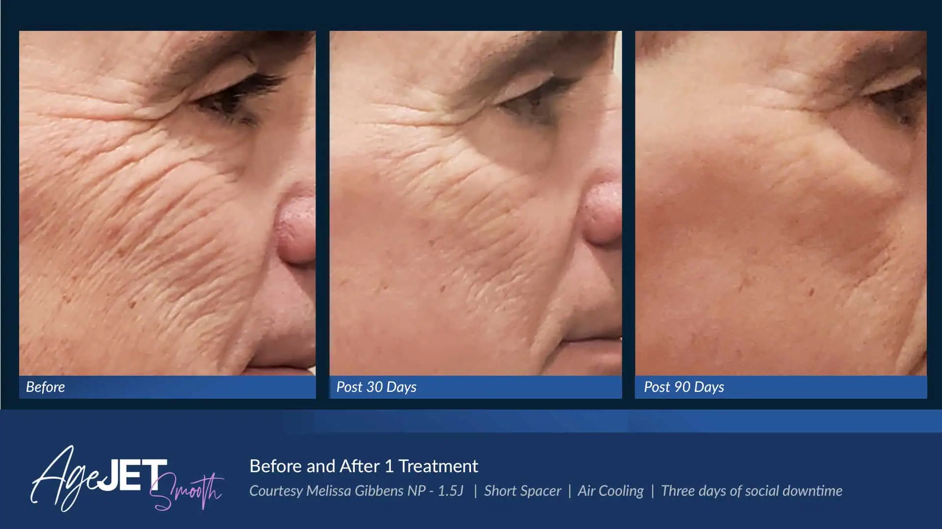 BA AgeJet Smooth Femaie Gibbens | Corpus Christi, TX | Coastal Glo Med Spa