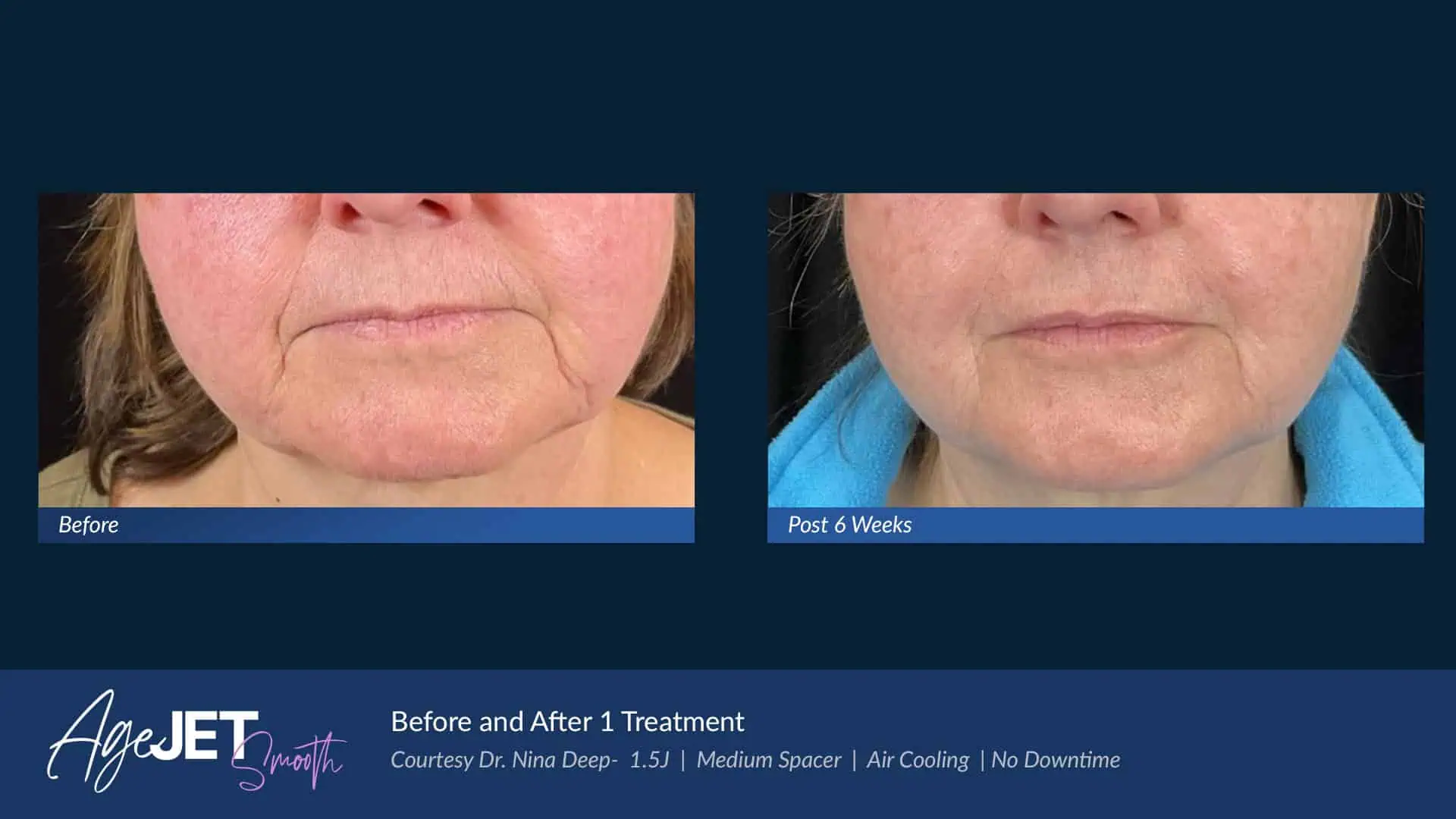 AgeJET Smooth Female Lips | Corpus Christi, TX | Coastal Glo Med Spa