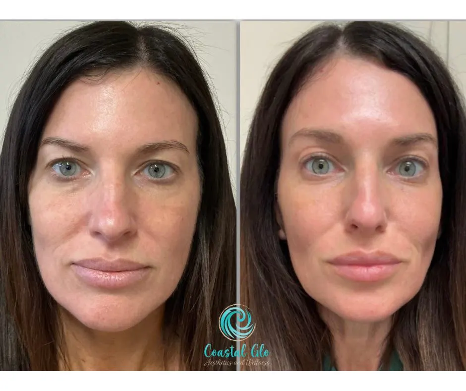 AgeJet 2 Week Treatment